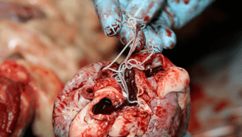 Helmintos in the heart